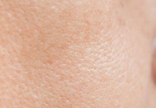 Larocheposay ArtikkelSide Akne Alt om akne og fet hud